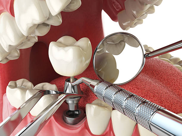Best Emergency Dental Care for Broken or Chipped Teeth in North Catasauqua, PA